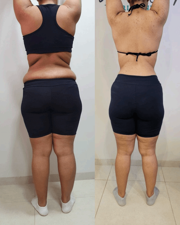 Recomposição corporal
